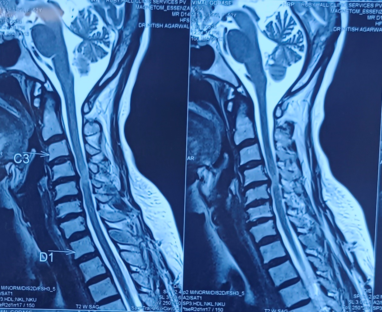 Cervical Disc Prolapse with Spinal Cord Compression