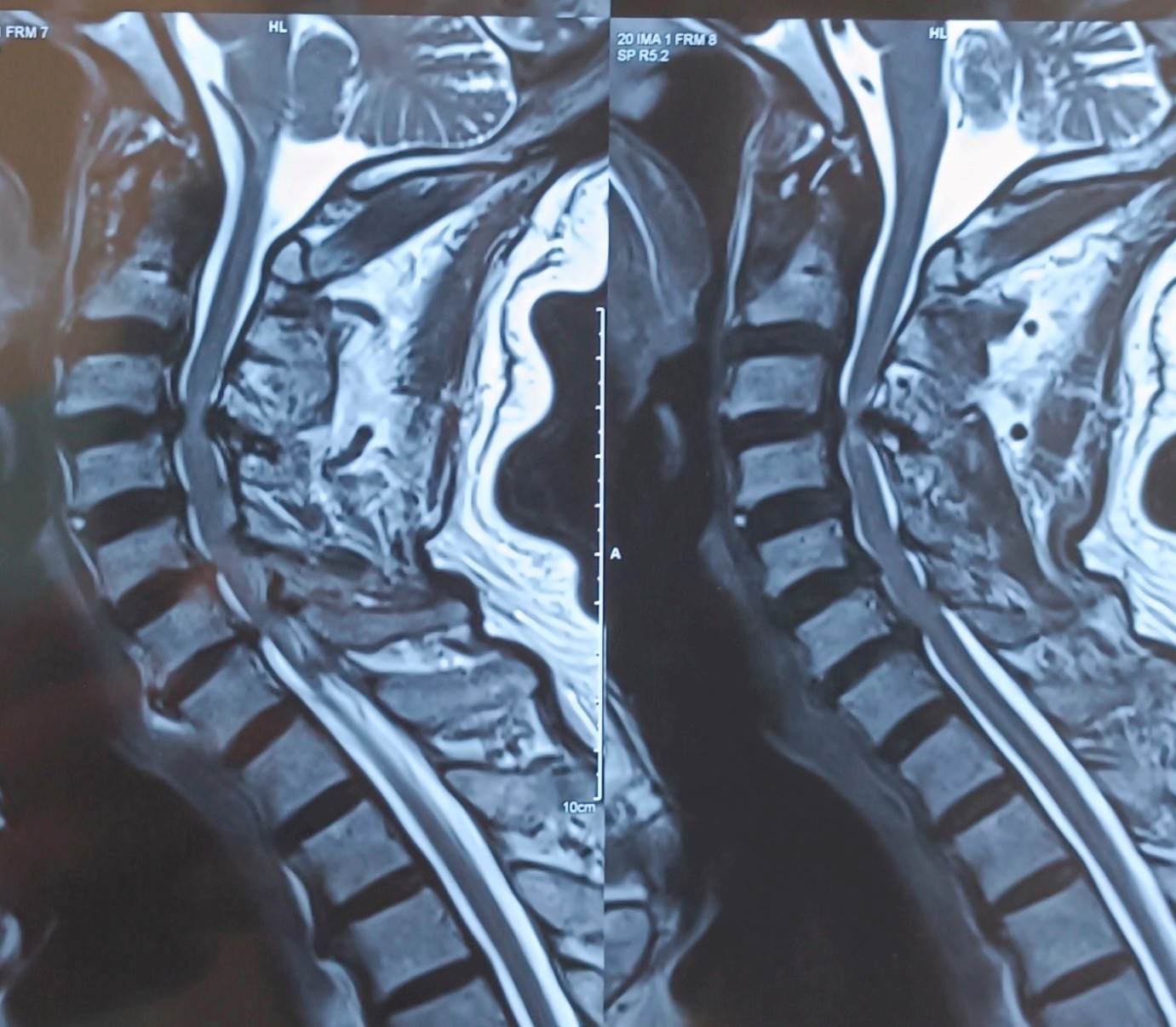 Cervical Myelopathy (Spinal Cord Compression)