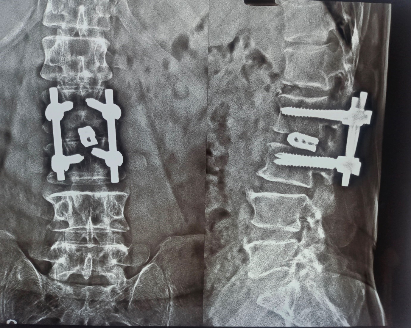 Cauda Equina Syndrome