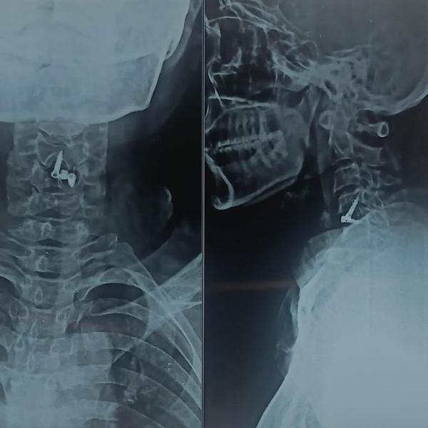 Cervical Disc Prolapse Treatment