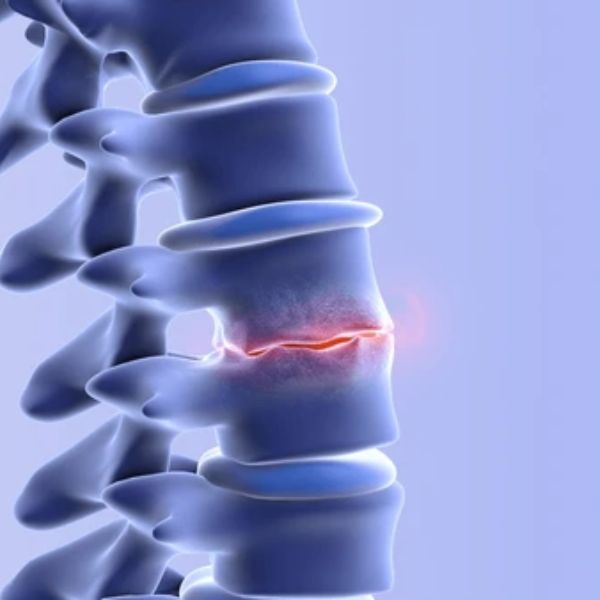 Degenerative Spine