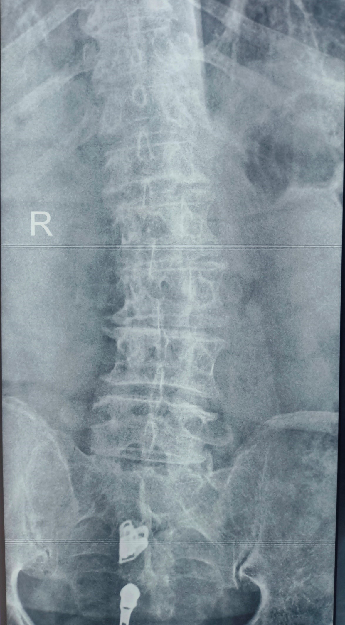 Degenerative Scoliosis & Severe Disc Degeneration