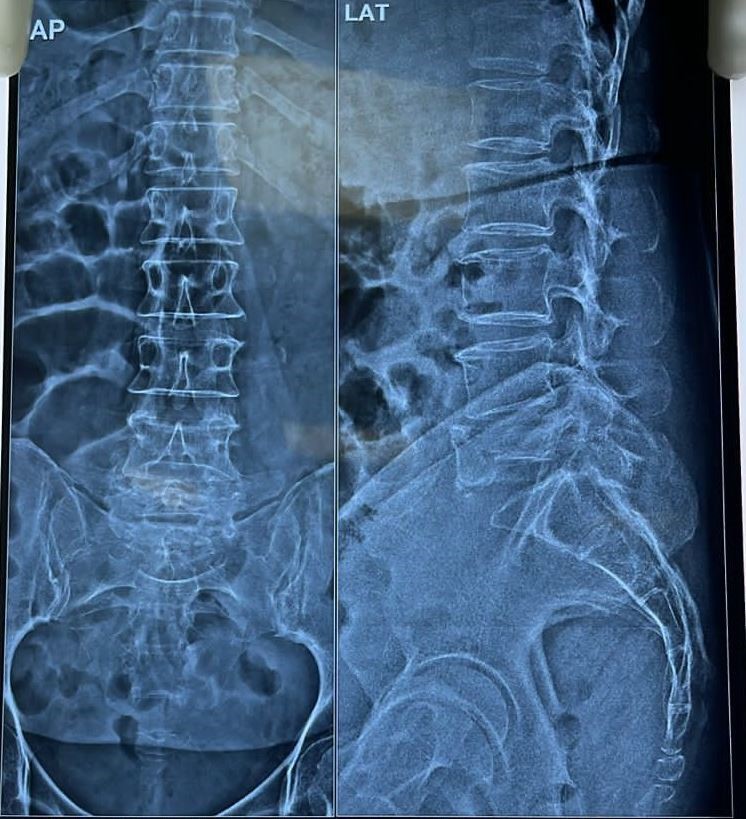 Post Chemotherapy & Radiotherapy Osteoporotic Spine Fracture