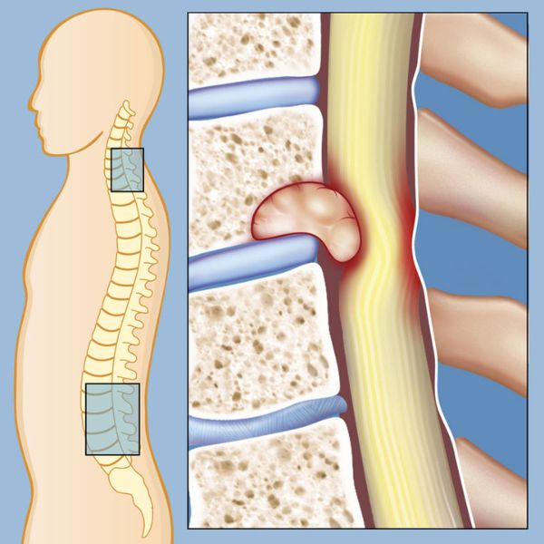 Spine Tumor & Oncology Care