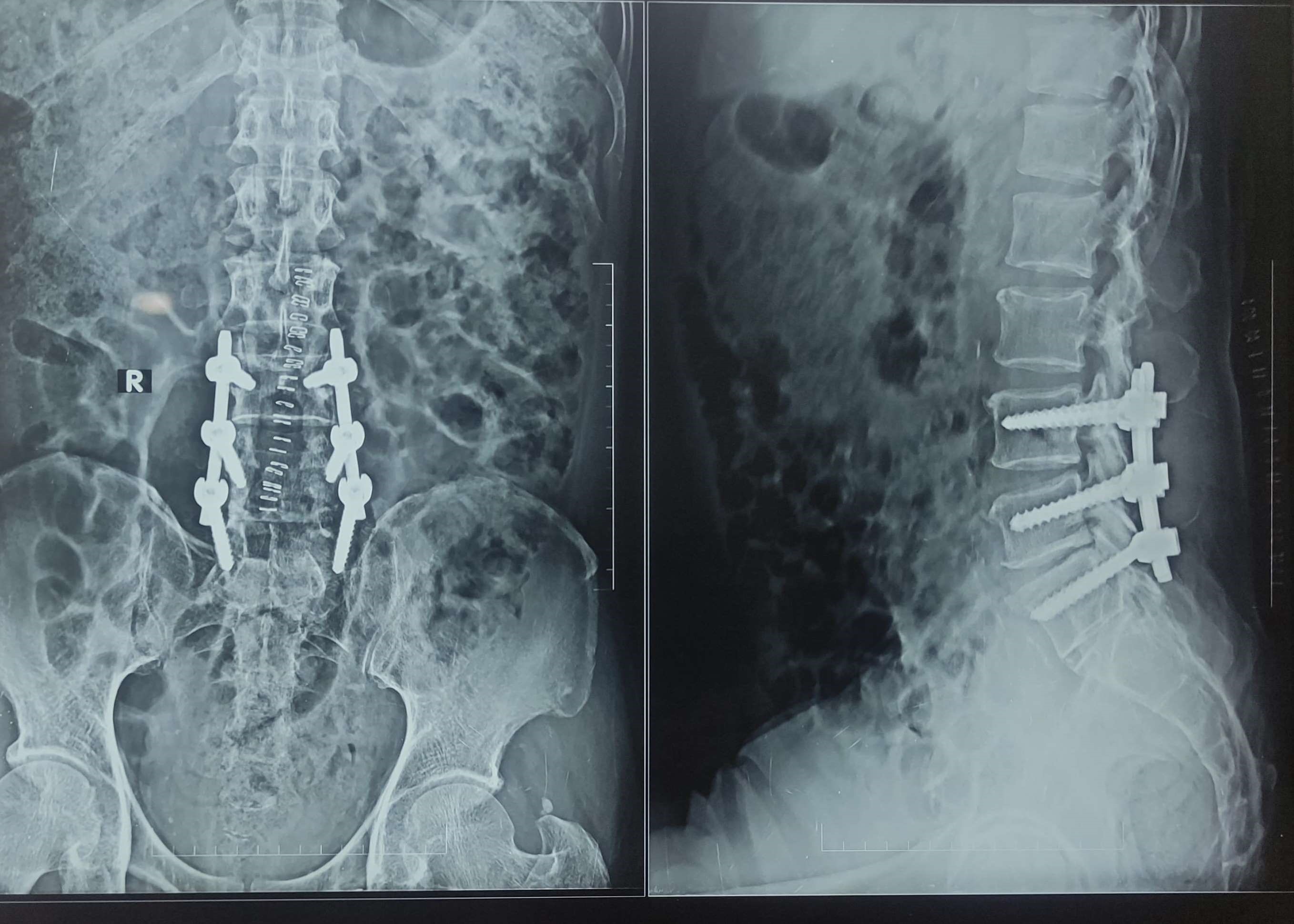 Spinal Canal Stenosis