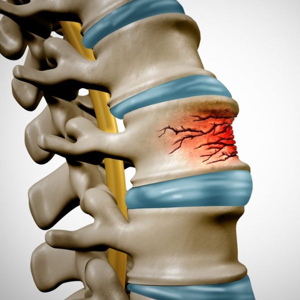 Spine Trauma & Fractures