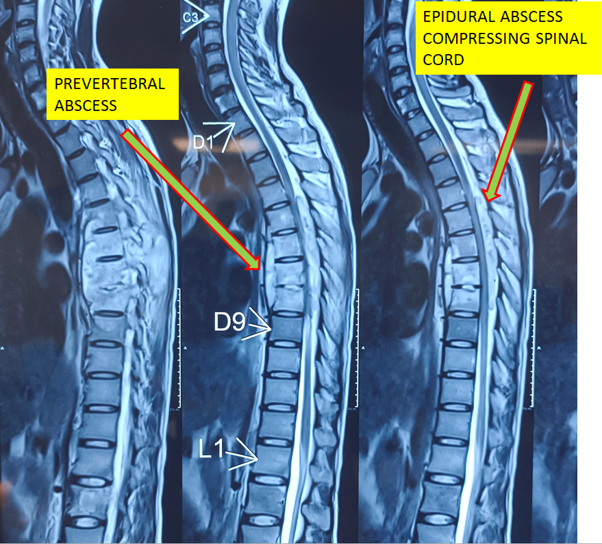 Spine Infection (Spondylodiscitis)