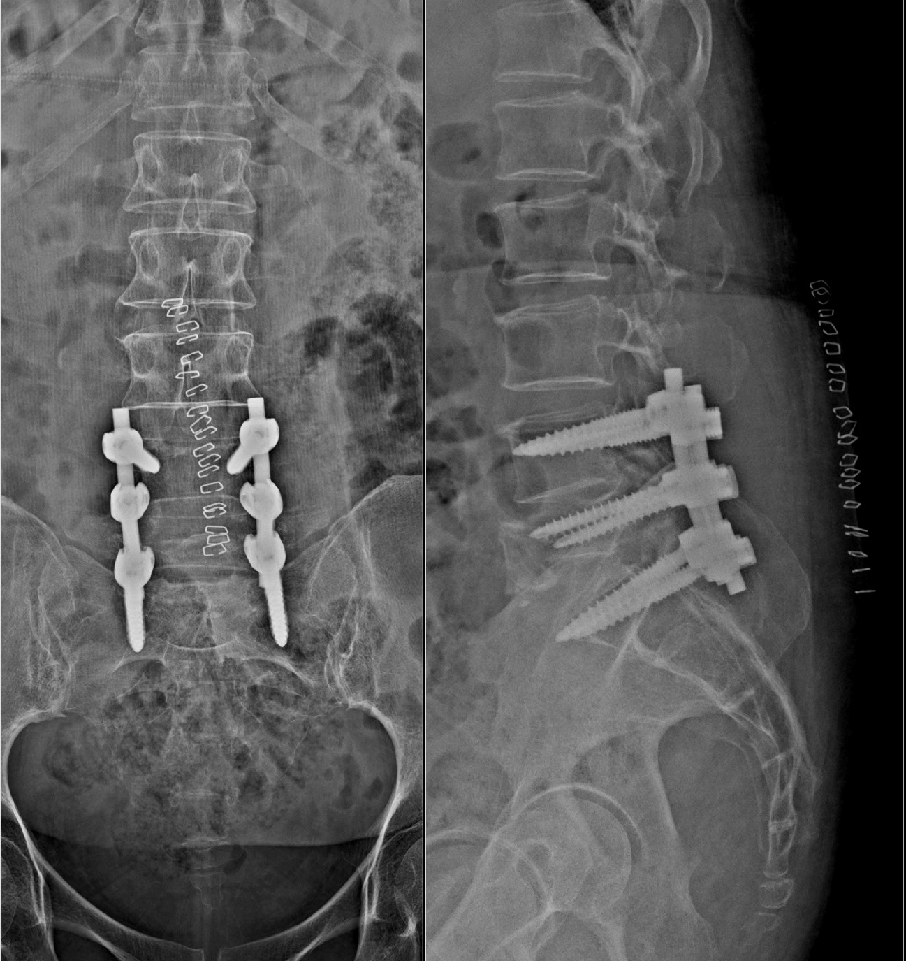 Tuberculosis Spine Infection (Pott’s Spine)