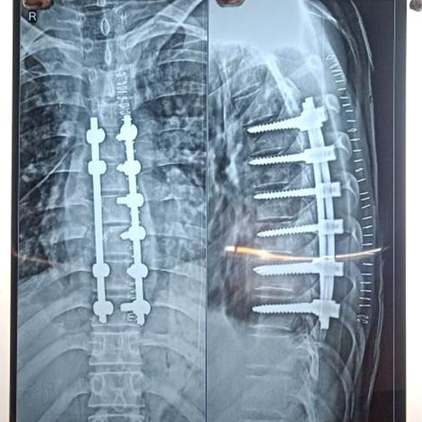 Tuberculosis Spine Treatment