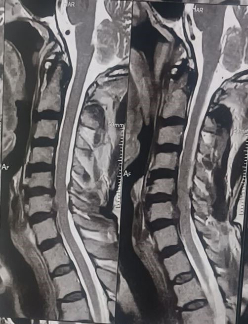 Cervical Radiculopathy (Pinched Nerve in Neck)