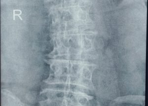 Degenerative scoliosis with severe disc degeneration
