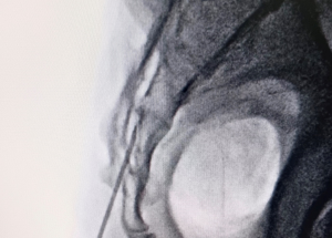 Non-Surgical Disc Prolapse Pain Management