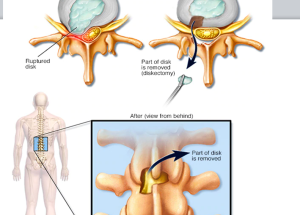 Sciatica or lumbar disc prolapse