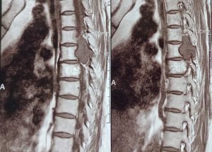 SPINE TUMOUR