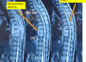 Spine infection
