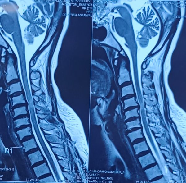 ANTERIOR CERVICAL DISCECTOMY AND FUSION ANTERIOR CERVICAL DISCECTOMY AND FUSION