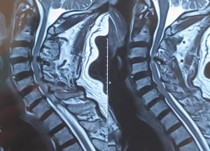 CERVICAL MYELOPATHY