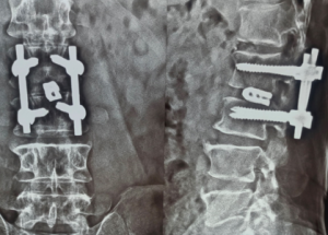 Cauda Equina Syndrome