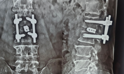Cauda Equina Syndrome Cauda Equina Syndrome