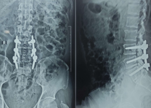 Spinal Canal Stenosis