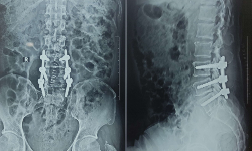 Spinal Canal Stenosis Spinal Canal Stenosis