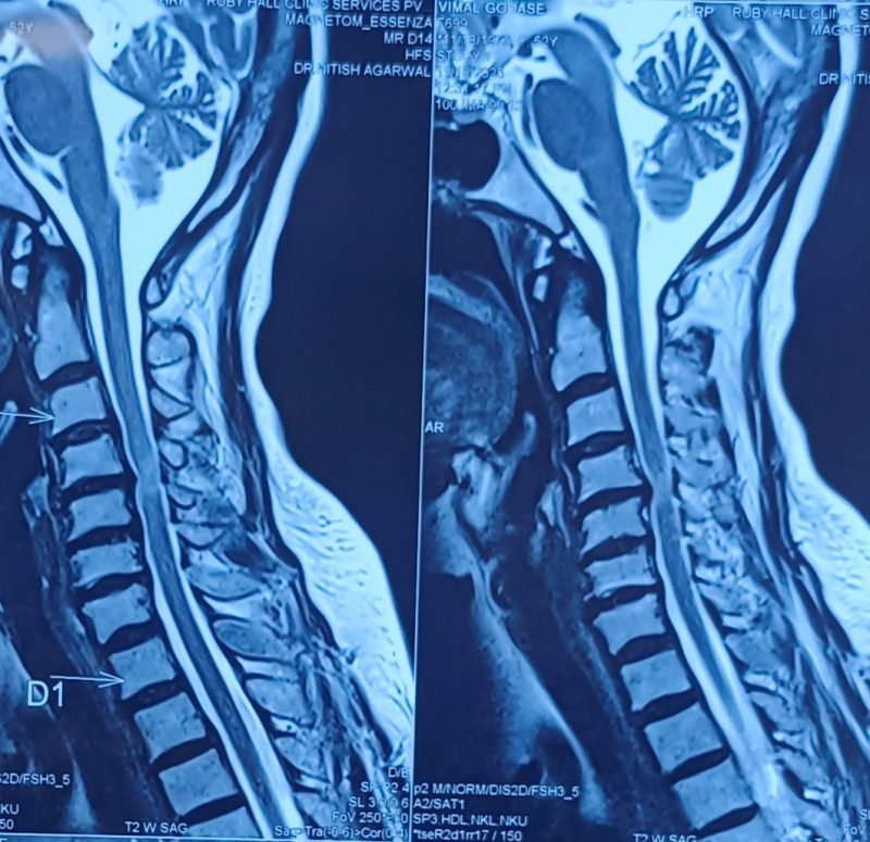 ANTERIOR CERVICAL DISCECTOMY AND FUSION