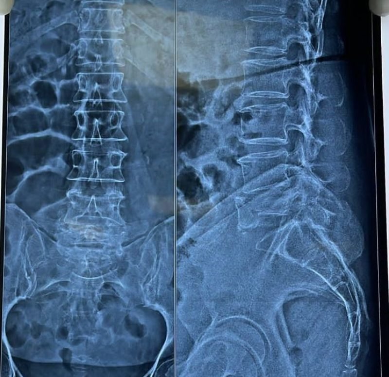 Osteoporotic Spine Fracture After Chemotherapy & Radiotherapy